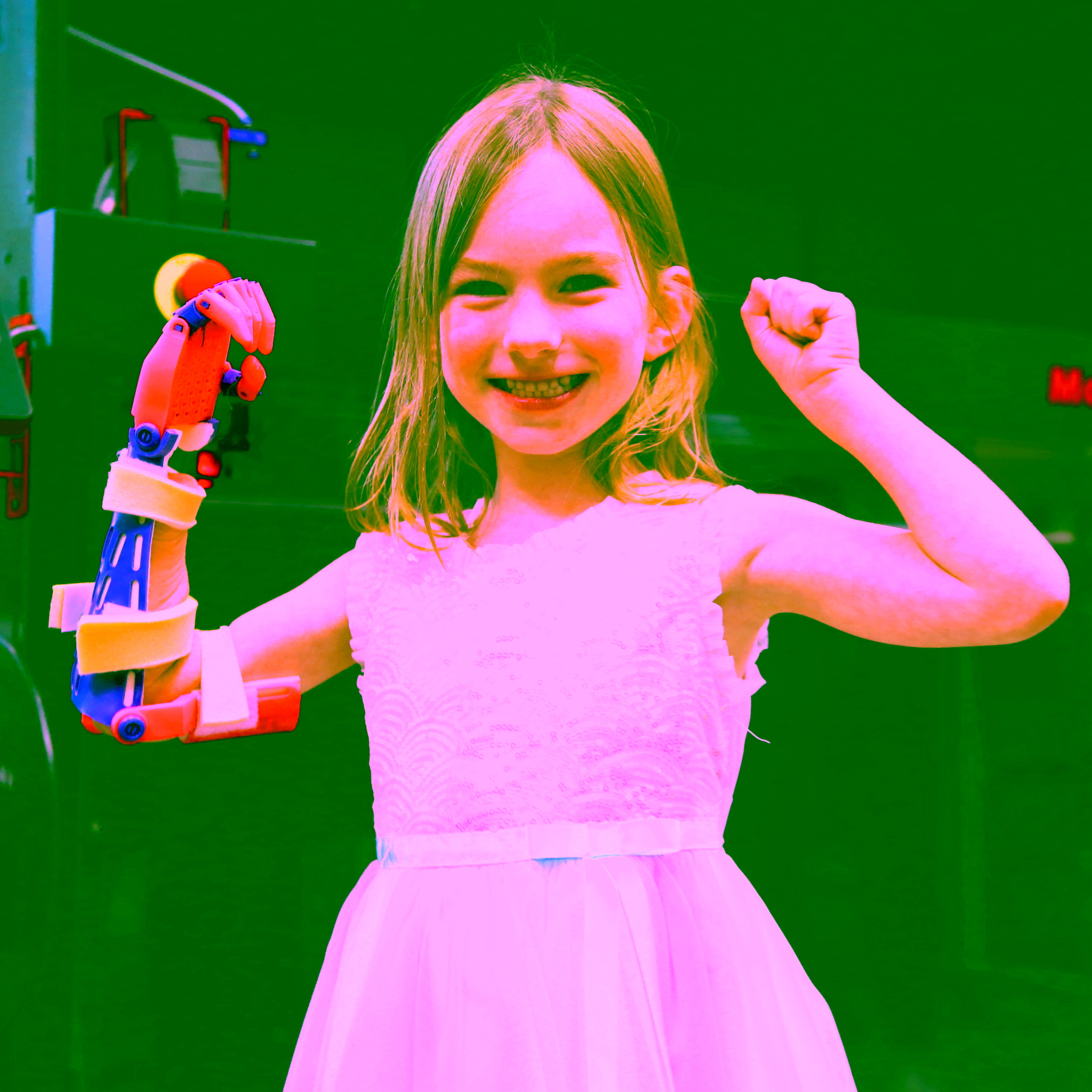 Young girl using upper arm prosthetic